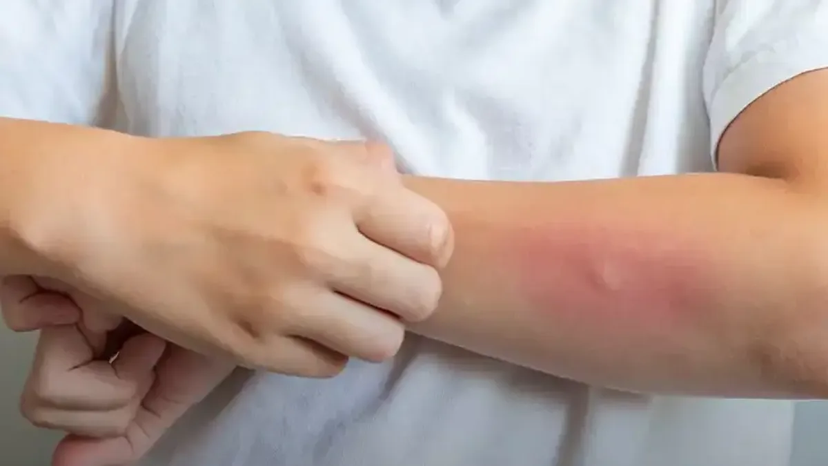 Egzama ciltle kalmayıp, sosyal hayatı da sarsıyor