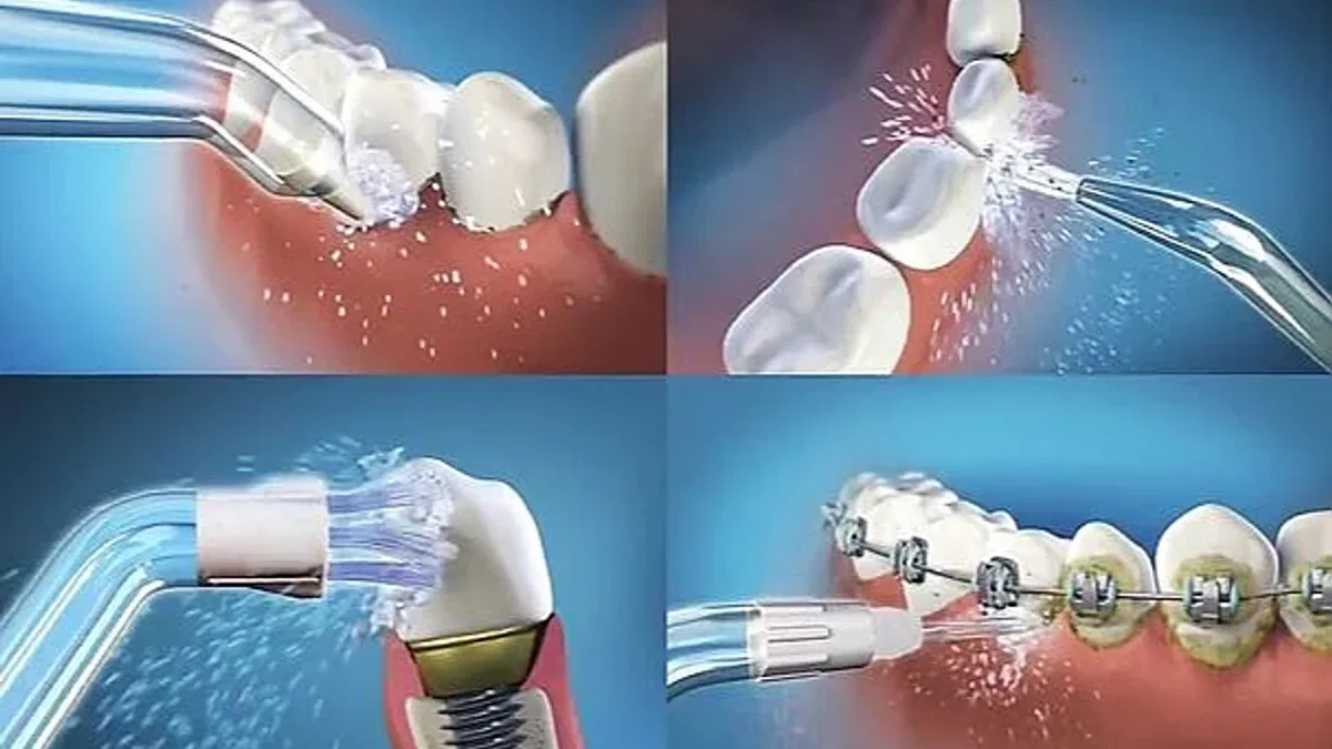 İmplant yaptıranların ağız bakımı da özel! Uzmanlar, implant çevresi için ağız duşlarını öneriyor…