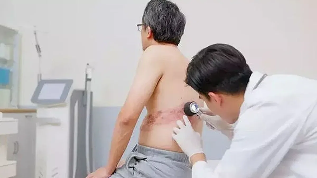 Bağışıklık Düşüklüğünde Zona Tehlikesine Dikkat!
